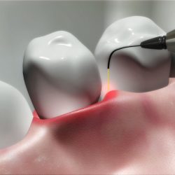 tratament laser